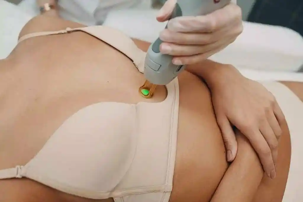 Laser hair removal around nipples for smooth skin