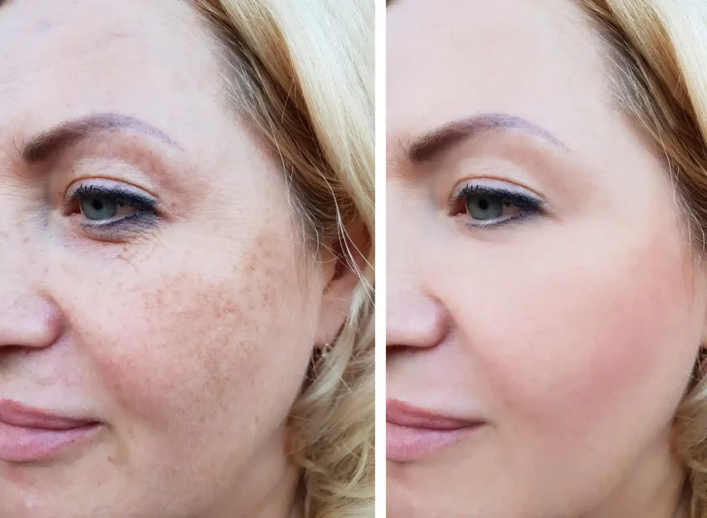 Client’s skin before and after a professional facial at arynova med spa