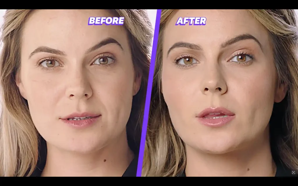 smile line filler before and after