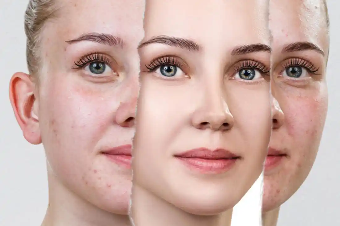 laser treatment for acne scars before and after