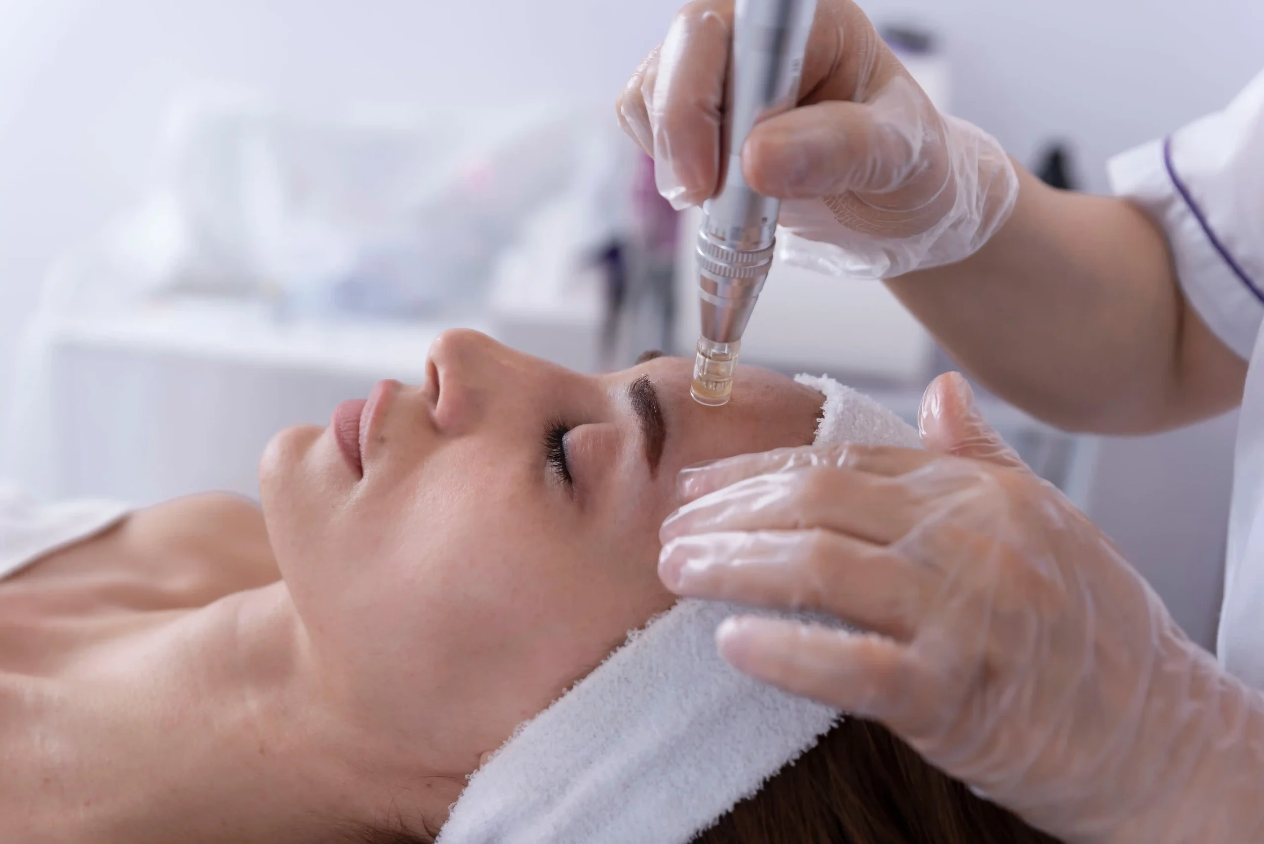 microneedling treatment and post care