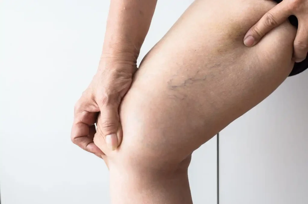 spider vein removal cost