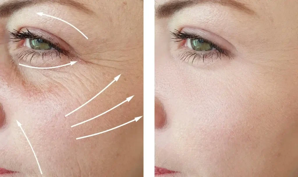 Microneedling treatment reducing fine lines and wrinkles