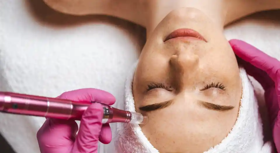 Microneedling at-home vs professional frequency
