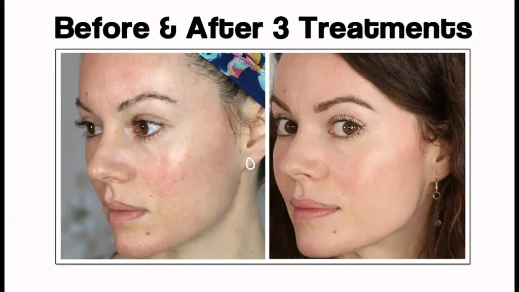 How long microneedling results last explained with before and after skin improvement result