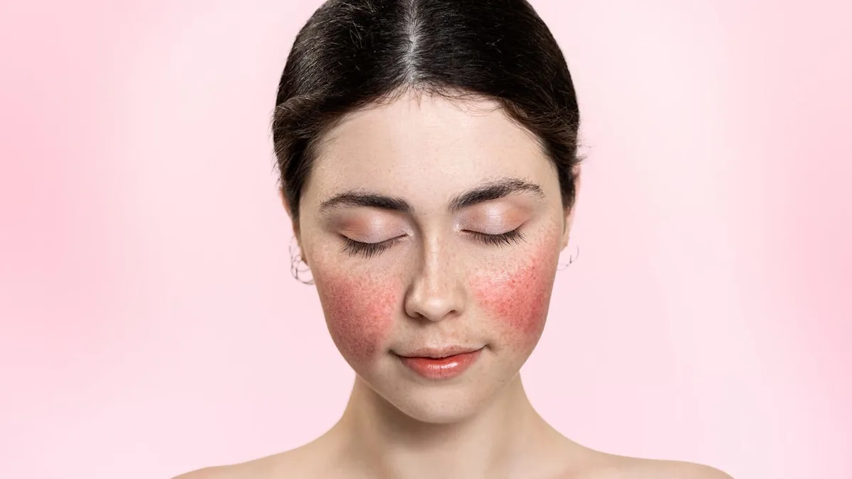 Rosacea Symptoms and Long-Term Management Solutions