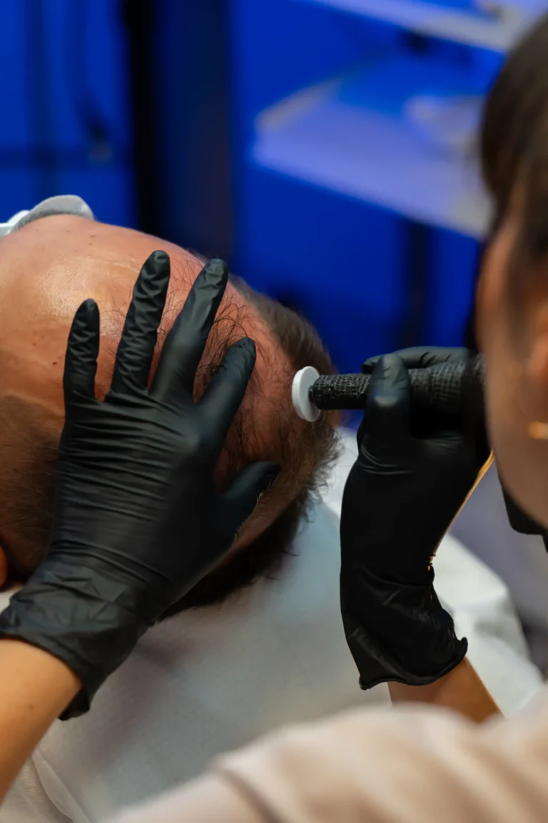 Scalp mesotherapy microneedle treatment for hair restoration at AryNova Aesthetics