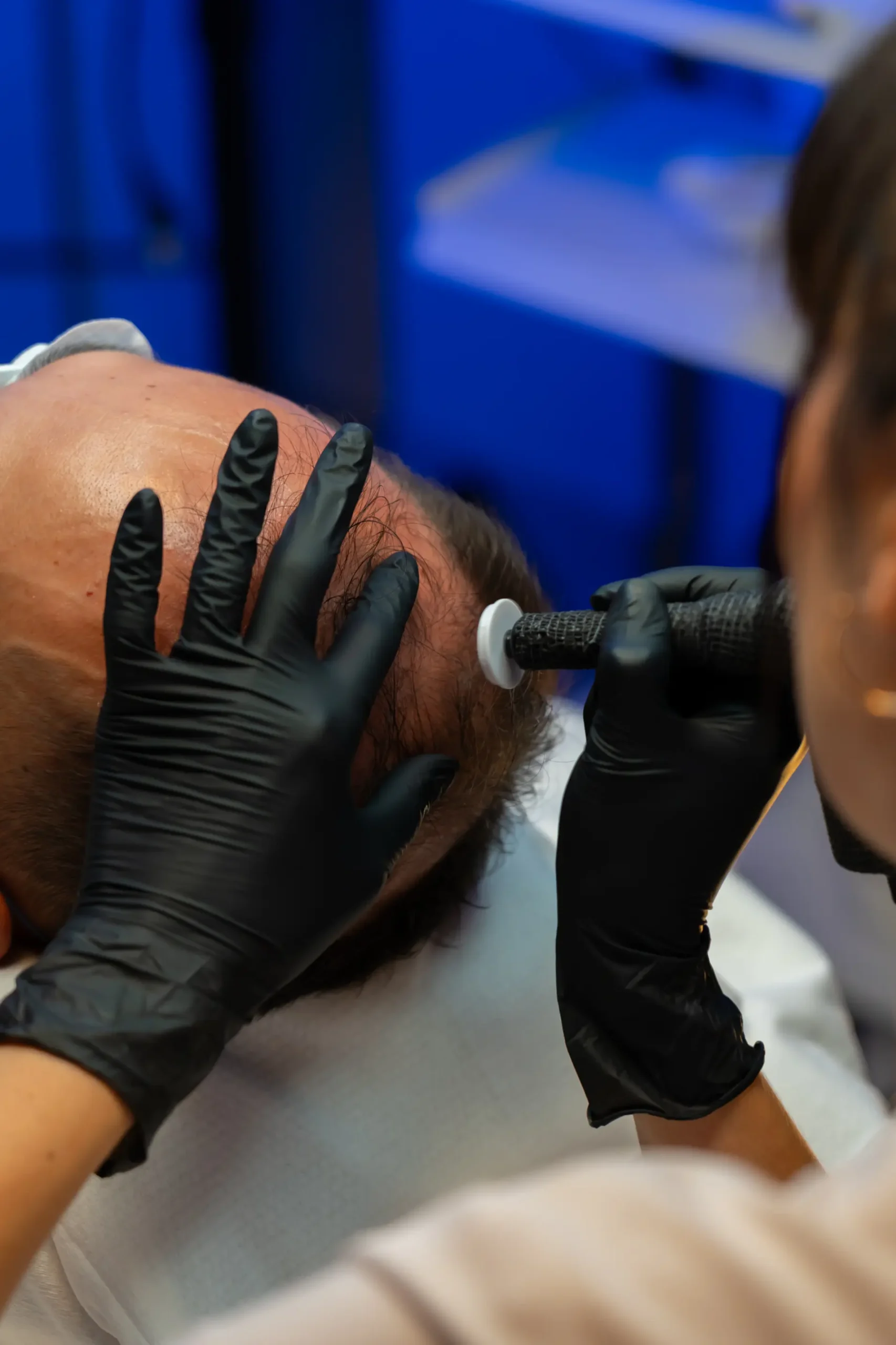 Scalp mesotherapy microneedle treatment for hair restoration at AryNova Aesthetics